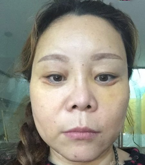 长期加班容易长眼袋就做超 声 波去眼袋不复发 长期加班容易长眼袋就做超 声 波去眼袋不复发