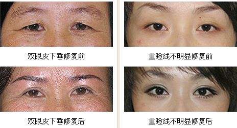 双眼皮做宽了能用超声波双眼皮修复吗?948 双眼皮做宽了能用超声波双眼皮修复吗?948