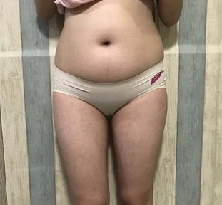 转变太大，超 声 波减肥很棒！