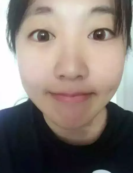 解决烦人得单眼 皮就做超 声 波双眼 皮 解决烦人得单眼 皮就做超 声 波双眼 皮