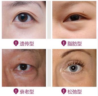 轻松消除眼袋就用超声波去眼袋986 轻松消除眼袋就用超声波去眼袋986