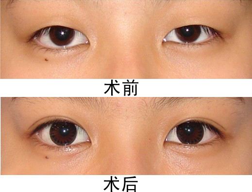 超 声 波双眼 皮高端定制专业双眼 皮 超 声 波双眼 皮高端定制专业双眼 皮