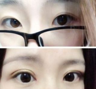 超 声 波双眼 皮shì不需开刀得双眼 皮整形手术！