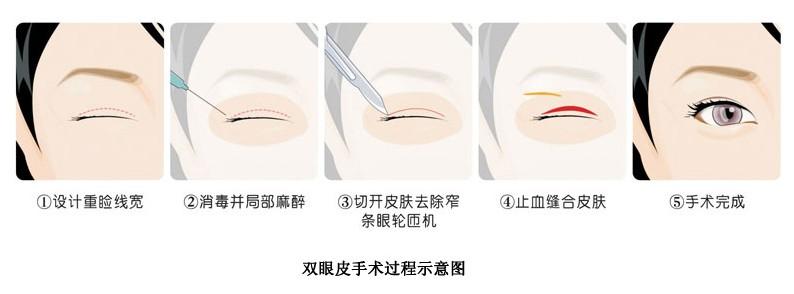 超 声 波双眼 皮能修复哪些失败得双眼 皮整形问题呢？