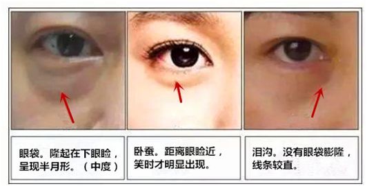 泪沟和眼袋是什么样的关系呢?