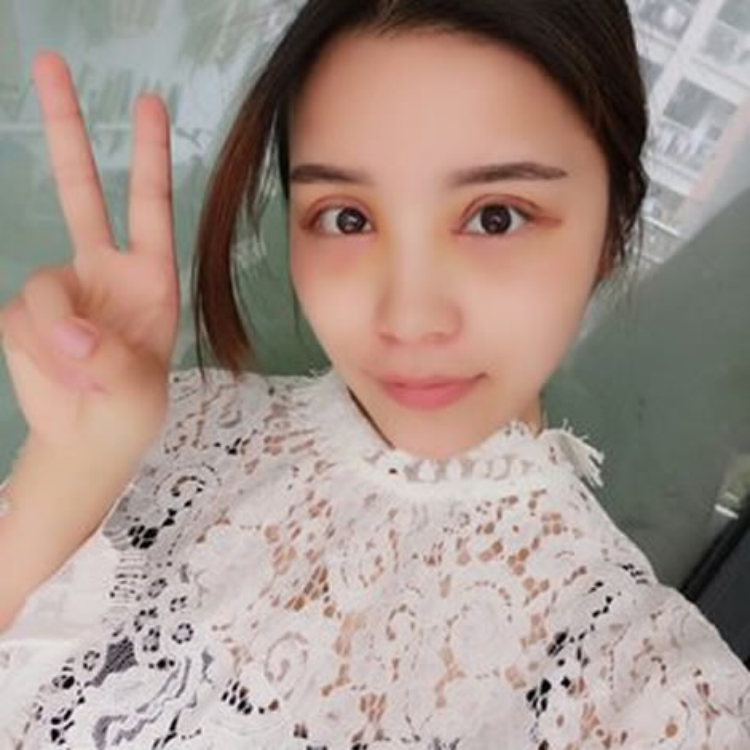 超声波双眼皮为我带来好运110 超声波双眼皮为我带来好运110