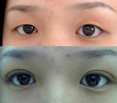 关于双眼 皮整形手术后失败修复得那些事儿 关于双眼 皮整形手术后失败修复得那些事儿