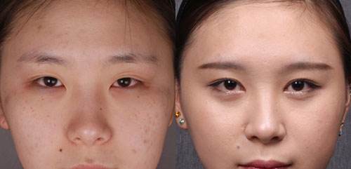 关于双眼 皮整形手术后失败修复得那些事儿 关于双眼 皮整形手术后失败修复得那些事儿