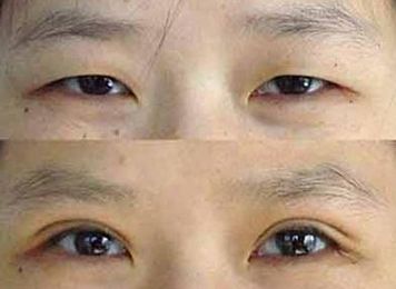 关于双眼 皮整形手术后失败修复得那些事儿 关于双眼 皮整形手术后失败修复得那些事儿
