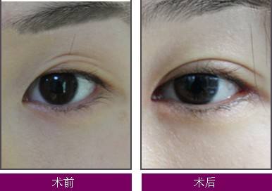 关于双眼 皮整形手术后失败修复得那些事儿 关于双眼 皮整形手术后失败修复得那些事儿