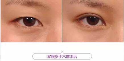 关于超 声 波双眼 皮,网友有话要说! 关于超 声 波双眼 皮,网友有话要说!