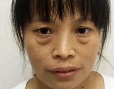 消除眼袋烦恼,超声波去眼袋你值得拥有!212 消除眼袋烦恼,超声波去眼袋你值得拥有!212