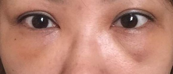 消除眼袋烦恼,超声波去眼袋你值得拥有!212 消除眼袋烦恼,超声波去眼袋你值得拥有!212