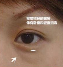 超 声 波去眼袋能轻松消除掉眼袋问题 超 声 波去眼袋能轻松消除掉眼袋问题