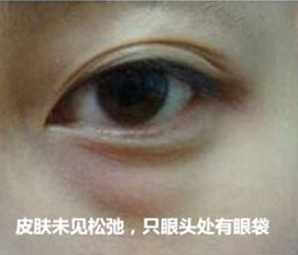 超 声 波去眼袋能轻松消除掉眼袋问题 超 声 波去眼袋能轻松消除掉眼袋问题