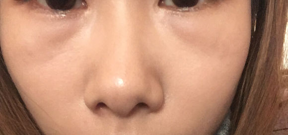 超声波去眼袋轻松改善眼袋困扰,还你明眸671 超声波去眼袋轻松改善眼袋困扰,还你明眸671