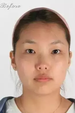 做不开刀隆鼻真的很自然啊745 做不开刀隆鼻真的很自然啊745