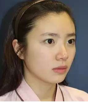 做不开刀隆鼻真的很自然啊745 做不开刀隆鼻真的很自然啊745
