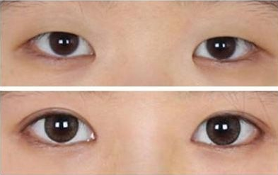 超 声 波双眼 皮后年纪大le会变形吗? 超 声 波双眼 皮后年纪大le会变形吗?