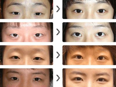 超声波双眼皮对眼睛有危害吗?722 超声波双眼皮对眼睛有危害吗?722