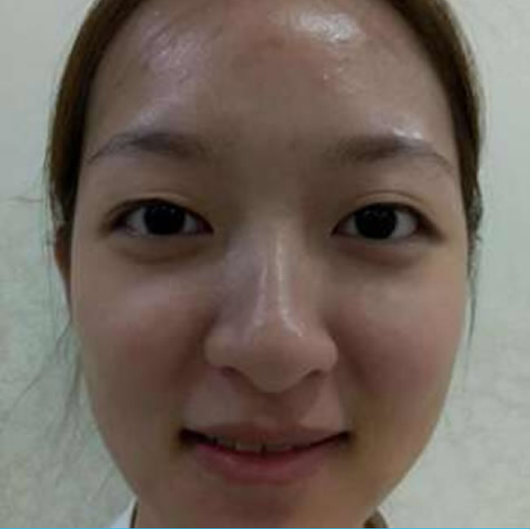 同事分享给我的美容方法——超声波双眼皮461 同事分享给我的美容方法——超声波双眼皮461