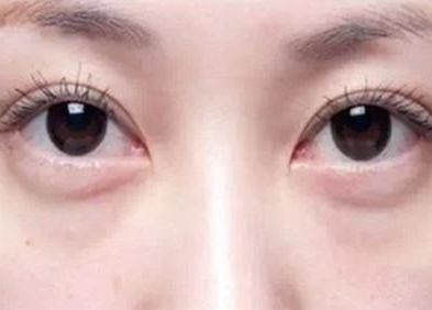 眼袋复发怎么办?做超声波去眼袋!861 眼袋复发怎么办?做超声波去眼袋!861