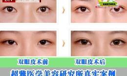 超 声 波双眼 皮砍获学长得爱情 超 声 波双眼 皮砍获学长得爱情