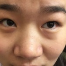 分享下超声波去眼袋手术的案例!769 分享下超声波去眼袋手术的案例!769