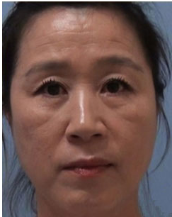 心疼我妈妈变老了,我带她去做了彭氏童颜术675 心疼我妈妈变老了,我带她去做了彭氏童颜术675