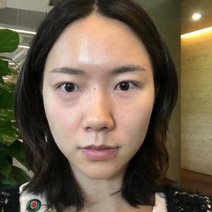 超 声 波去眼袋手术后眼部皮肤嫩嫩得 超 声 波去眼袋手术后眼部皮肤嫩嫩得