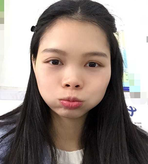 我最终做了超声波去眼袋让我眼袋消除了771 我最终做了超声波去眼袋让我眼袋消除了771