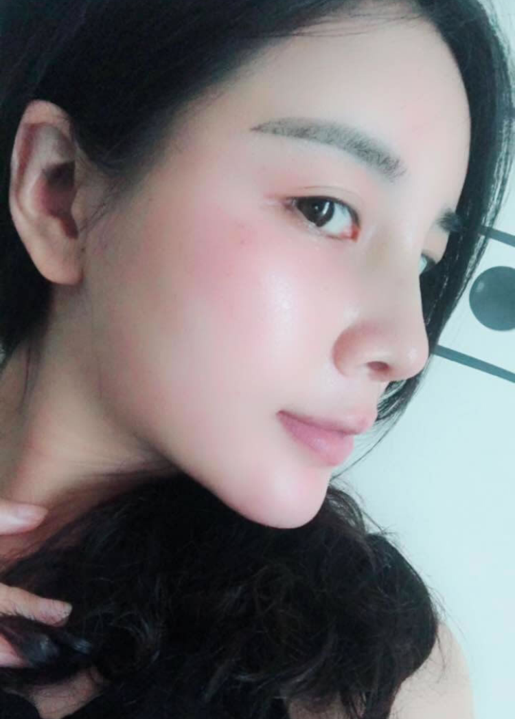 我表嫂做了不开刀隆鼻以后鼻子变高了541 我表嫂做了不开刀隆鼻以后鼻子变高了541