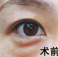 超 声 波去眼袋手术有副作用吗 超 声 波去眼袋手术有副作用吗