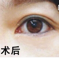 超 声 波去眼袋手术有副作用吗 超 声 波去眼袋手术有副作用吗