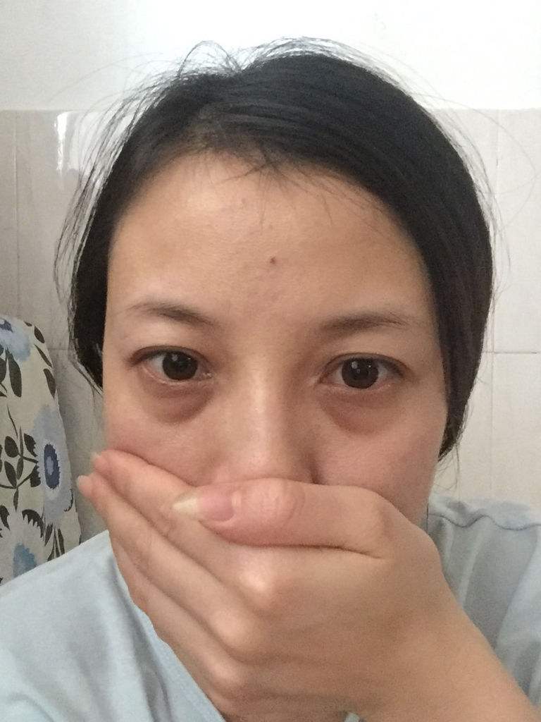 去眼袋可以不需开刀——超声波去眼袋769 去眼袋可以不需开刀——超声波去眼袋769