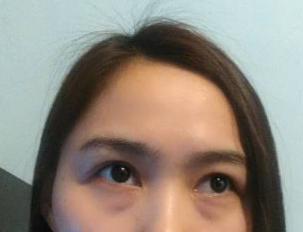 超声波去眼袋消除眼袋,让年龄再返回来!022 超声波去眼袋消除眼袋,让年龄再返回来!022