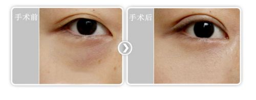 超声波去眼袋扶平眼袋的同时收紧皮肤403 超声波去眼袋扶平眼袋的同时收紧皮肤403