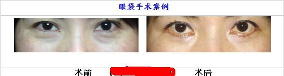 超声波去眼袋扶平眼袋的同时收紧皮肤403 超声波去眼袋扶平眼袋的同时收紧皮肤403