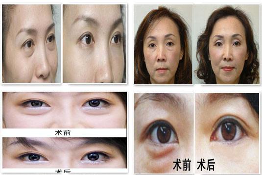 超声波去眼袋扶平眼袋的同时收紧皮肤403 超声波去眼袋扶平眼袋的同时收紧皮肤403