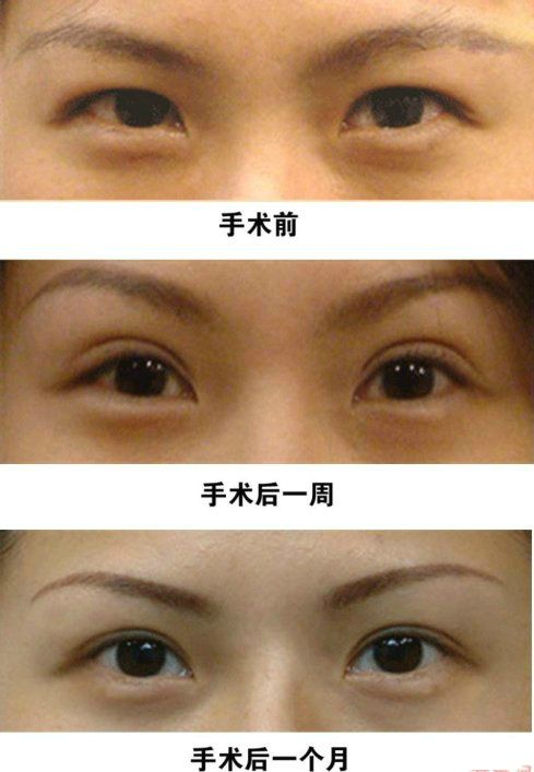 超 声 波双眼 皮完美修复失败双眼 皮，给你明亮大眼睛