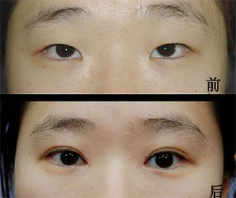 超 声 波双眼 皮完美修复失败双眼 皮，给你明亮大眼睛