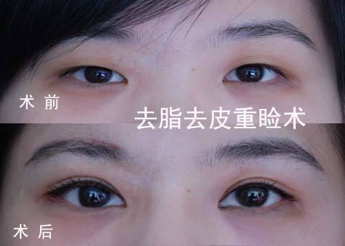 超声波双眼皮能够修复双眼皮手术造成的上睑外翻吗？736