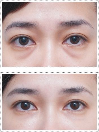 如何解决眼袋?超声波去眼袋就不错514 如何解决眼袋?超声波去眼袋就不错514
