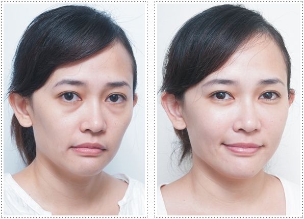 如何解决眼袋?超声波去眼袋就不错514 如何解决眼袋?超声波去眼袋就不错514