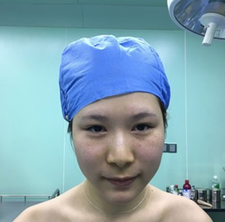 不做绿叶我选择了做超声波双眼皮让自己变美424 不做绿叶我选择了做超声波双眼皮让自己变美424