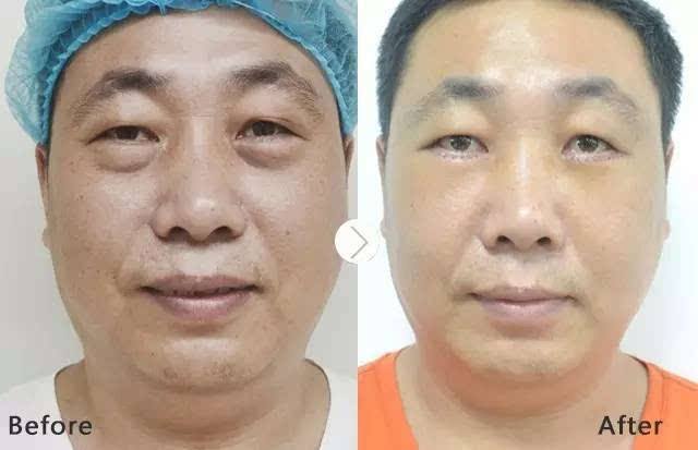 去眼袋手术你了解多少？让超声波技术发明人解答！600