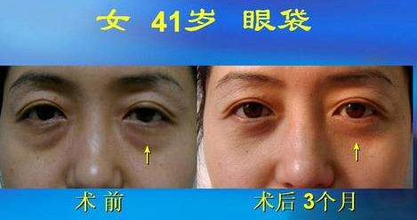 超声波去眼袋手术对眼睛的伤害大不大?462 超声波去眼袋手术对眼睛的伤害大不大?462