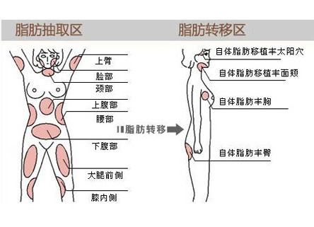 超 声 波自体脂肪丰胸常见问题有哪些呢? 超 声 波自体脂肪丰胸常见问题有哪些呢?