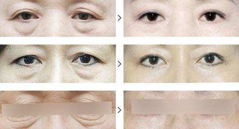 拒绝显老眼袋——超 声 波去眼袋 拒绝显老眼袋——超 声 波去眼袋