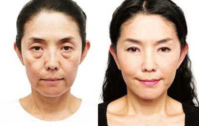 拒绝显老眼袋——超 声 波去眼袋 拒绝显老眼袋——超 声 波去眼袋